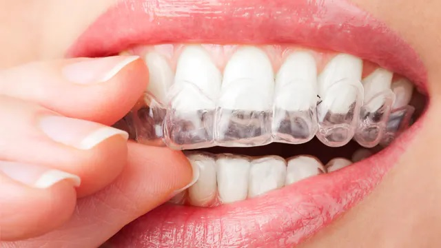 Top 5 Best Teeth Whitening Kits