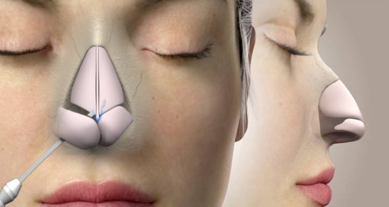 Things To Know About Rhinoplasty With Cartilage
