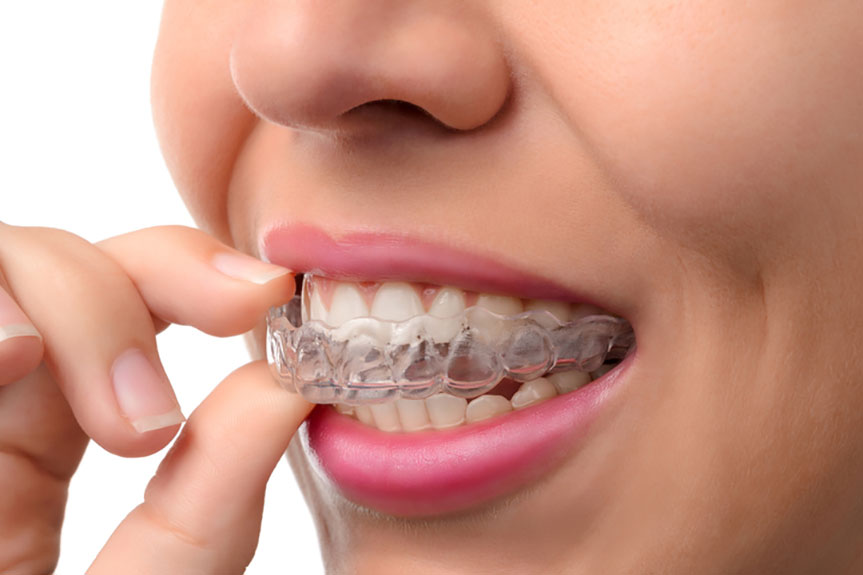 Transforming Smiles with Invisalign: The Power of Clarity