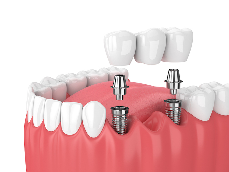 Types of Abutments in Dental Implantology: Which One Is Right for You in Lawton?