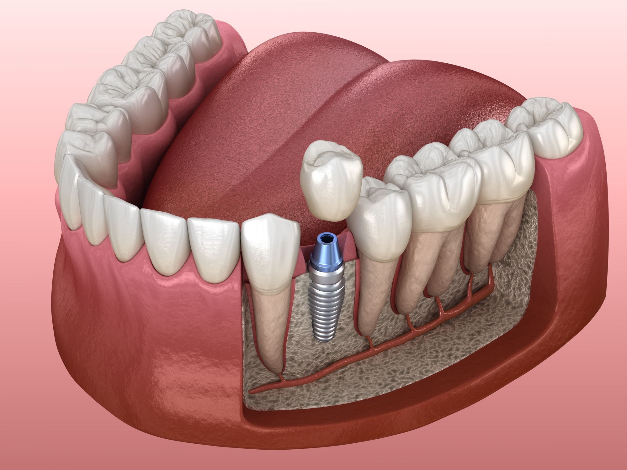 Dental Implants and Bone Health: Preserving Jawbone Density for Long-Term Success