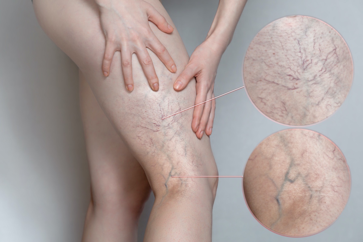 Is Spider Vein Treatment Right for You?