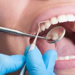 Why Professional Teeth Whitening Remains A Popular Choice For Brighter Smiles